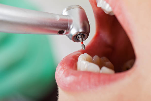 Best Emergency Dental Extractions in Petersburg, VA